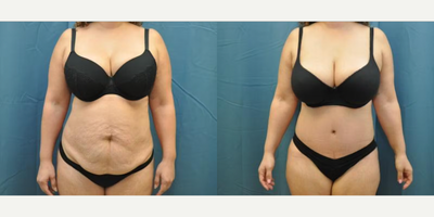 Case 118 - Woman treated with Tummy Tuck