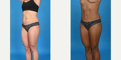 Case 1180 - 35-44 year old woman treated with Abdominal Etching, BodyTite, Diastasis Recti Repair, Drainless Tummy Tuck, Liposculpture, Lipo