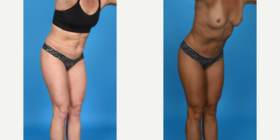 Case 1181 - 35-44 year old woman treated with Abdominal Etching, BodyTite, Diastasis Recti Repair, Drainless Tummy Tuck, Liposculpture, Lipo