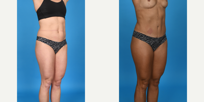 Case 1182 - 35-44 year old woman treated with Abdominal Etching, BodyTite, Diastasis Recti Repair, Drainless Tummy Tuck, Liposculpture, Lipo