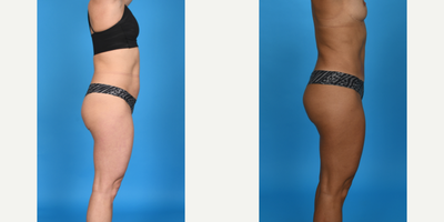 Case 1183 - 35-44 year old woman treated with Abdominal Etching, BodyTite, Diastasis Recti Repair, Drainless Tummy Tuck, Liposculpture, Lipo