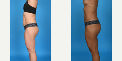 Case 1184 - 35-44 year old woman treated with Abdominal Etching, BodyTite, Diastasis Recti Repair, Drainless Tummy Tuck, Liposculpture, Lipo