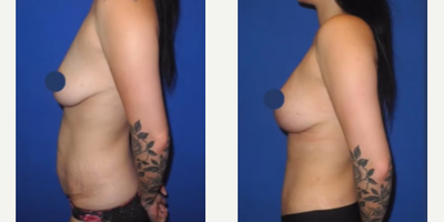 Case 1185 - Woman treated with Breast Lift, Breast Fat Transfer, Tummy Tuck, Liposuction, Mommy Makeover