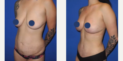 Case 1186 - Woman treated with Breast Lift, Breast Fat Transfer, Tummy Tuck, Liposuction, Mommy Makeover