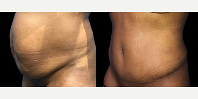Case 1187 - Woman treated with Tummy Tuck, Liposuction