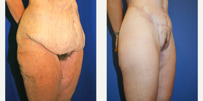 Case 1188 - Woman treated with Tummy Tuck