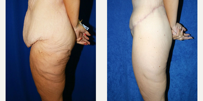 Case 1189 - Woman treated with Tummy Tuck
