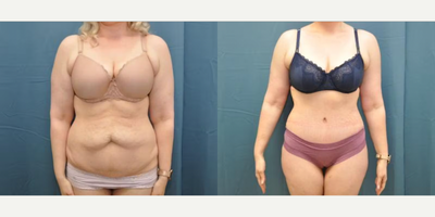 Case 119 - Woman treated with Tummy Tuck