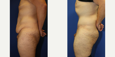 Case 1190 - Man treated with Tummy Tuck