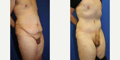 Case 1191 - Man treated with Tummy Tuck