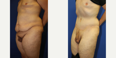 Case 1192 - Man treated with Tummy Tuck