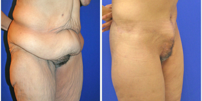 Case 1193 - 55-64 year old woman treated with Tummy Tuck