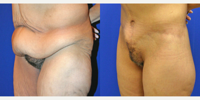 Case 1194 - 55-64 year old woman treated with Tummy Tuck