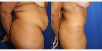 Case 1195 - 35-44 year old woman treated with Tummy Tuck