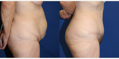 Case 1196 - 35-44 year old woman treated with Tummy Tuck