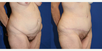 Case 1197 - 45-54 year old woman treated with Tummy Tuck