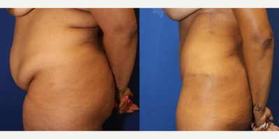 Case 1198 - 35-44 year old woman treated with Tummy Tuck