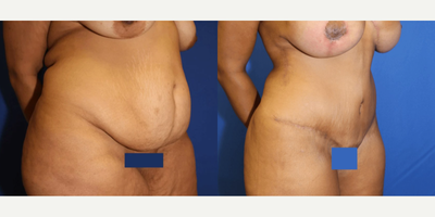 Case 1199 - 35-44 year old woman treated with Tummy Tuck