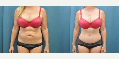 Case 120 - Woman treated with Tummy Tuck