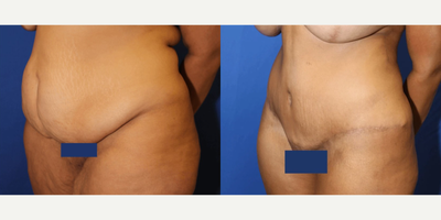 Case 1200 - 35-44 year old woman treated with Tummy Tuck