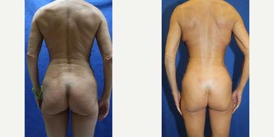 Case 1201 - 45-54 year old woman treated with Tummy Tuck