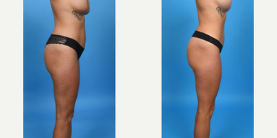 Case 1206 - 25-34 year old woman treated with BodyTite, Drainless Tummy Tuck, Liposculpture, Liposuction, Liposuction Revision, Mini Tummy T