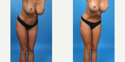 Case 1207 - 25-34 year old woman treated with BodyTite, Drainless Tummy Tuck, Liposculpture, Liposuction, Liposuction Revision, Mini Tummy T