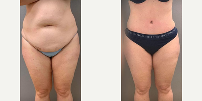 Case 1209 - Woman treated with Tummy Tuck