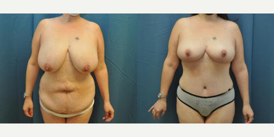 Case 121 - Woman treated with Tummy Tuck