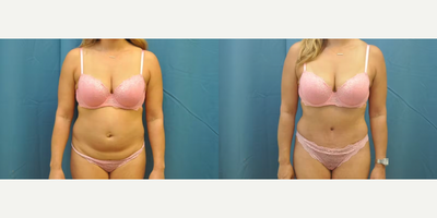 Case 1210 - Woman treated with Tummy Tuck