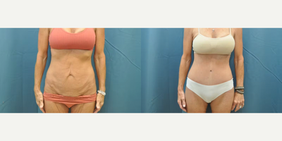 Case 1211 - Woman treated with Tummy Tuck