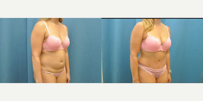 Case 1212 - Woman treated with Tummy Tuck