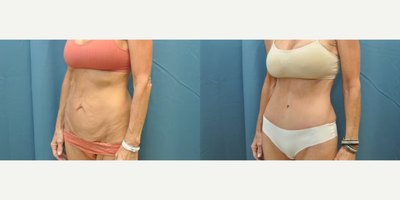 Case 1213 - Woman treated with Tummy Tuck