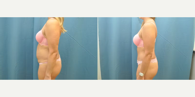 Case 1214 - Woman treated with Tummy Tuck