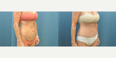 Case 1215 - Woman treated with Tummy Tuck