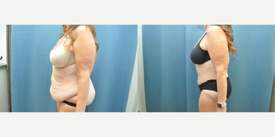 Case 1216 - Woman treated with Tummy Tuck