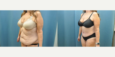 Case 1217 - Woman treated with Tummy Tuck