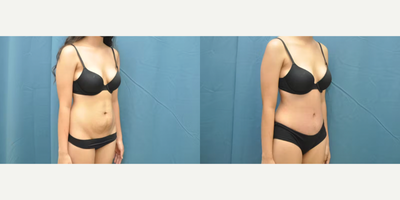 Case 1218 - Woman treated with Tummy Tuck