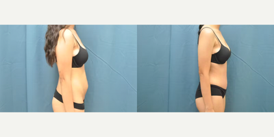 Case 1219 - Woman treated with Tummy Tuck