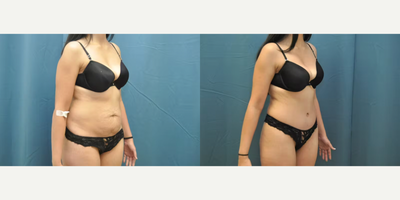 Case 1220 - Woman treated with Tummy Tuck