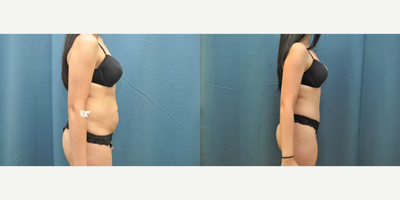 Case 1221 - Woman treated with Tummy Tuck