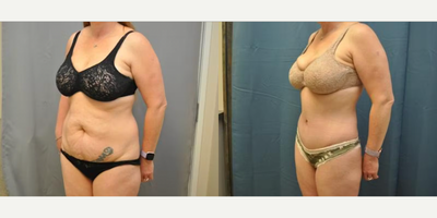 Case 1222 - Woman treated with Tummy Tuck