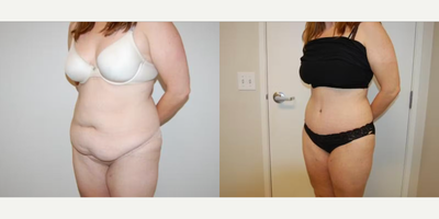 Case 1223 - Woman treated with Tummy Tuck