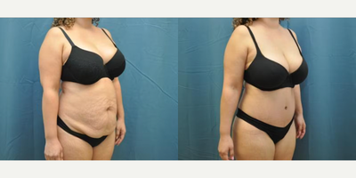 Case 1224 - Woman treated with Tummy Tuck