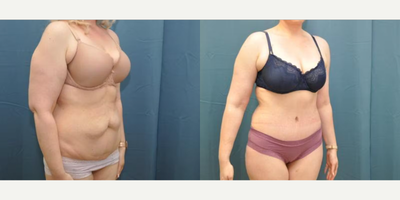 Case 1225 - Woman treated with Tummy Tuck