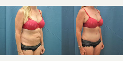 Case 1226 - Woman treated with Tummy Tuck