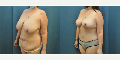 Case 1227 - Woman treated with Tummy Tuck