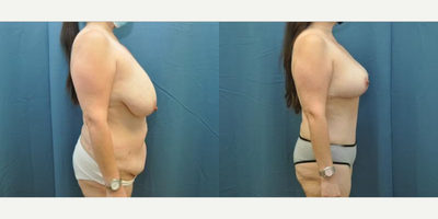 Case 1228 - Woman treated with Tummy Tuck