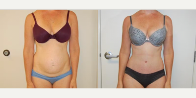 Case 1229 - Woman treated with Tummy Tuck