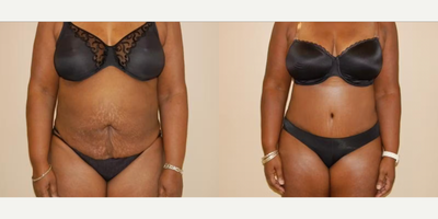 Case 123 - Woman treated with Tummy Tuck